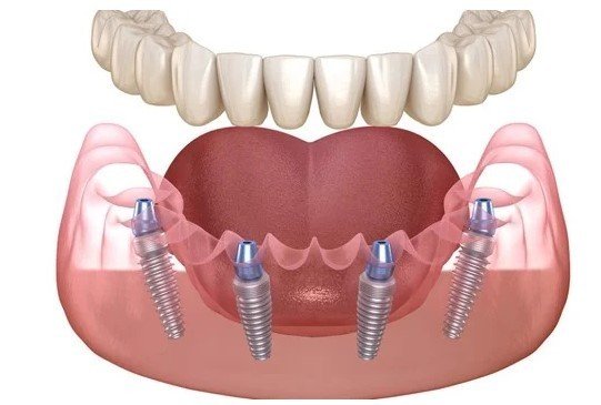 Trồng răng Implant toàn hàm All On 4