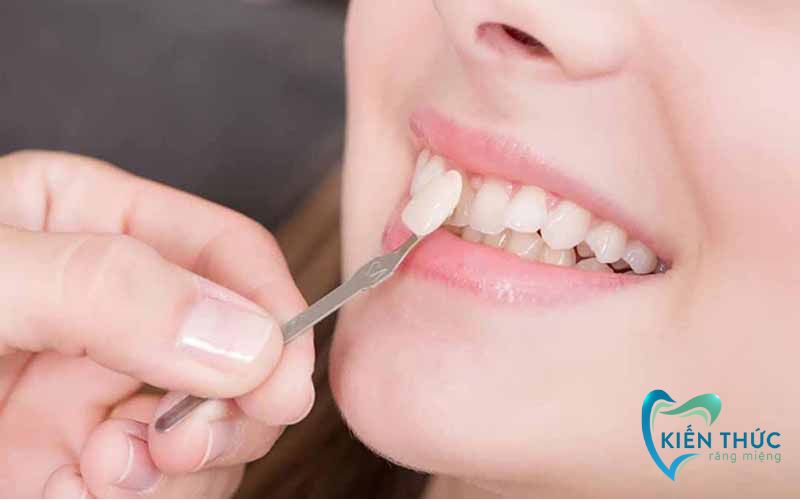 Quy trình bọc răng sứ tại Nha khoa gồm 5 bước