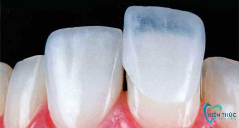 Chi phí dán răng sứ Veneer hiện nay tại các nha khoa