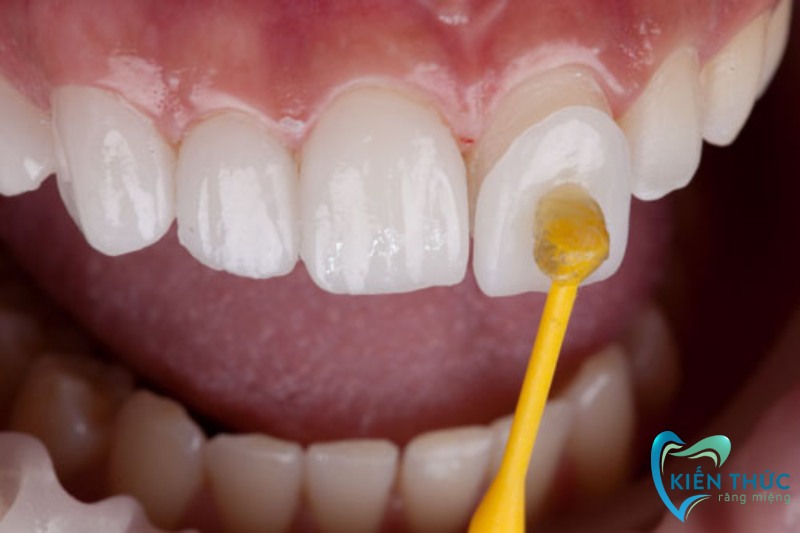 Dán cố định mặt dán sứ vào mặt răng bằng keo dán nha khoa chuyên dụng