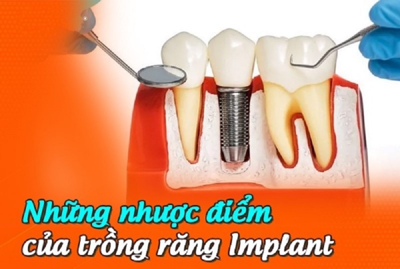 Nhược điểm của trồng răng Implant