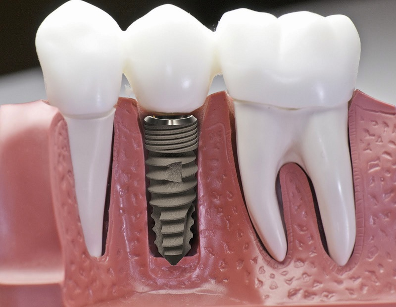 Trồng răng Implant là gì