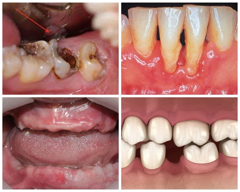 4 nhóm khách hàng có thể thực hiện quy trình làm răng Implant chuẩn Y khoa