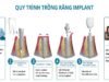 6 bước quy trình trồng răng Implant chuẩn Y khoa mà bạn nên biết