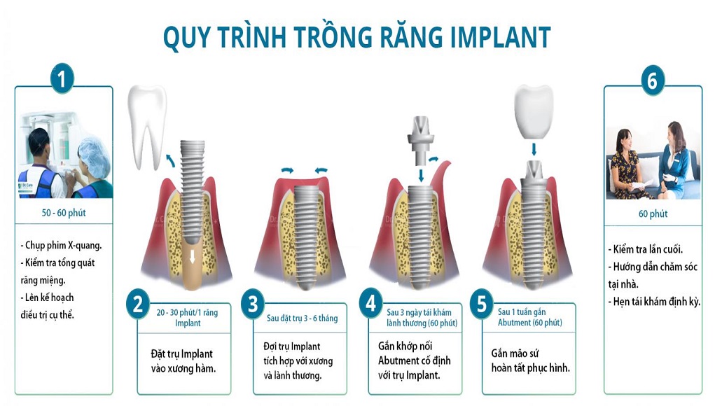 6 bước quy trình trồng răng Implant chuẩn Y khoa mà bạn nên biết