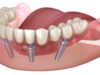 trồng răng Implant toàn hàm