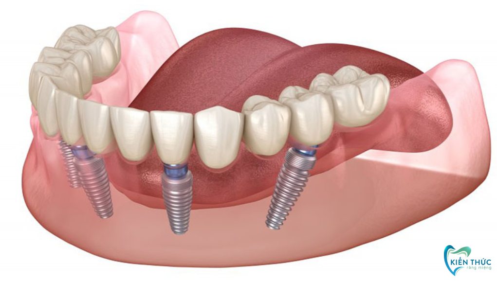 trồng răng Implant toàn hàm