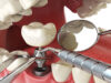 Trồng răng Implant là gì? Điều cần chú ý khi cấy ghép Implant