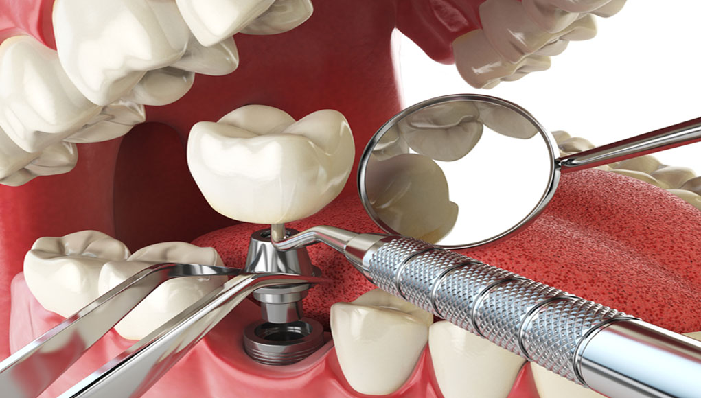 Trồng răng Implant là gì? Điều cần chú ý khi cấy ghép Implant