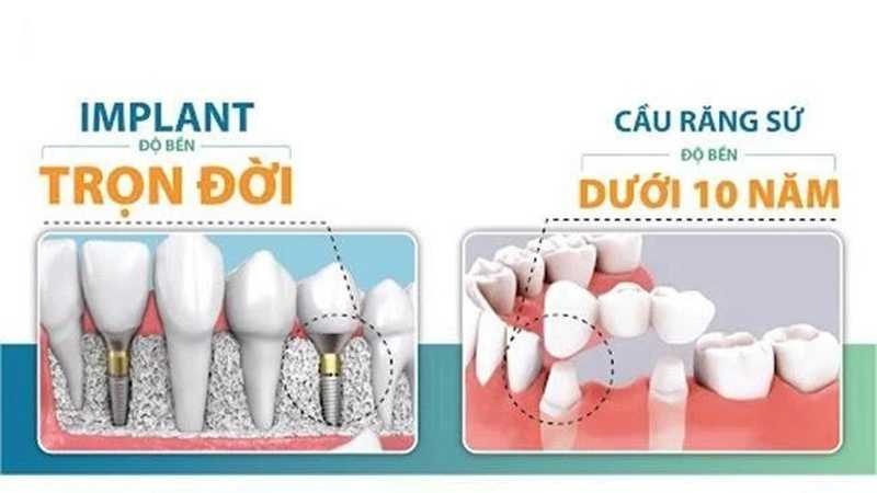 Trồng răng Implant nếu vệ sinh kỹ càng trụ Implant có thể dùng trọn đời