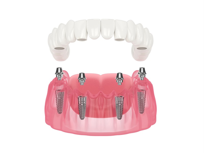 Phương pháp trồng răng Implant toàn hàm (trồng Implant nguyên hàm)
