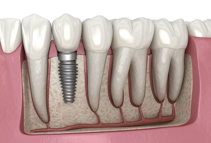 Ngăn chặn tiêu xương răng bằng cấy ghép trụ Implant