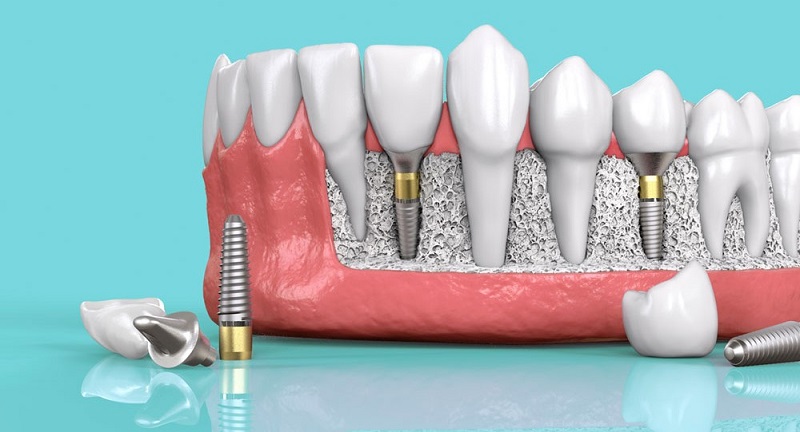 Yếu tố giúp trồng răng không đau