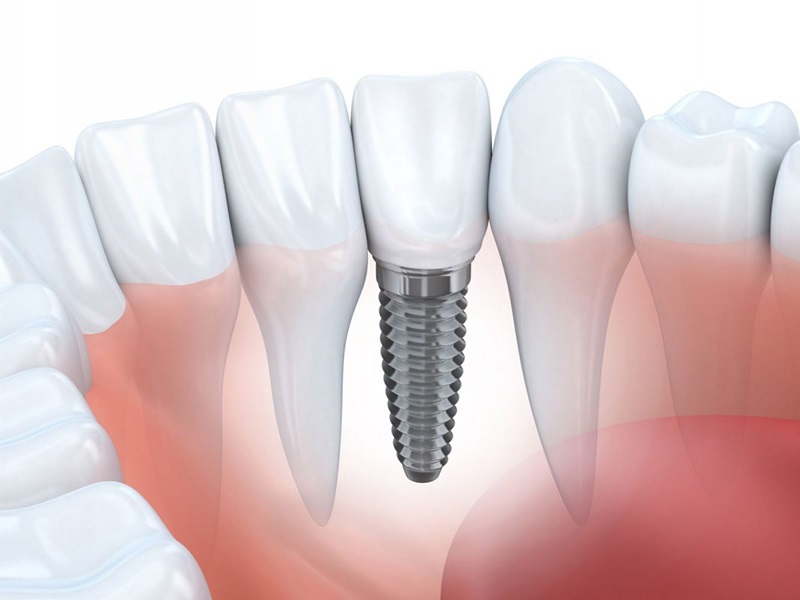 Hiệu quả của việc trồng răng Implant