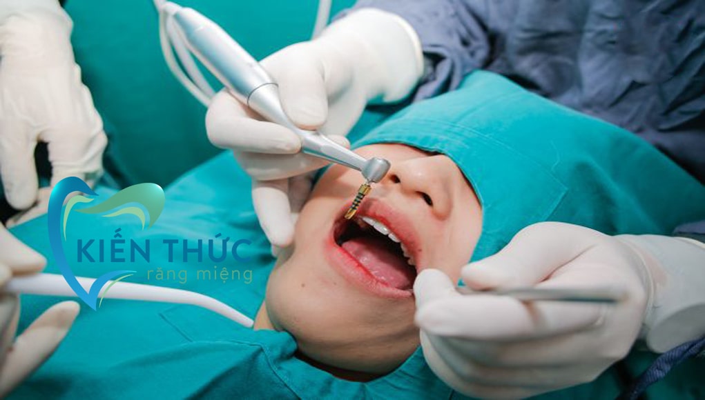 Trồng răng Implant có đau không