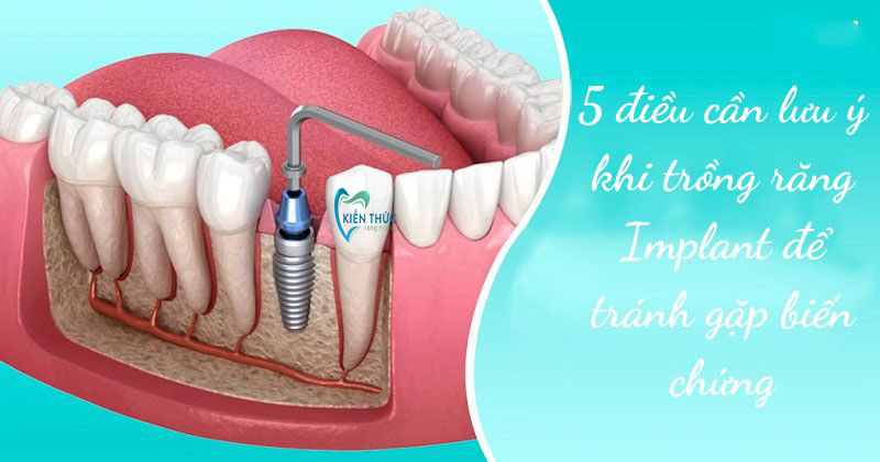 5 điều cần lưu ý khi trồng răng Implant để tránh gặp biến chứng sau phẫu thuật