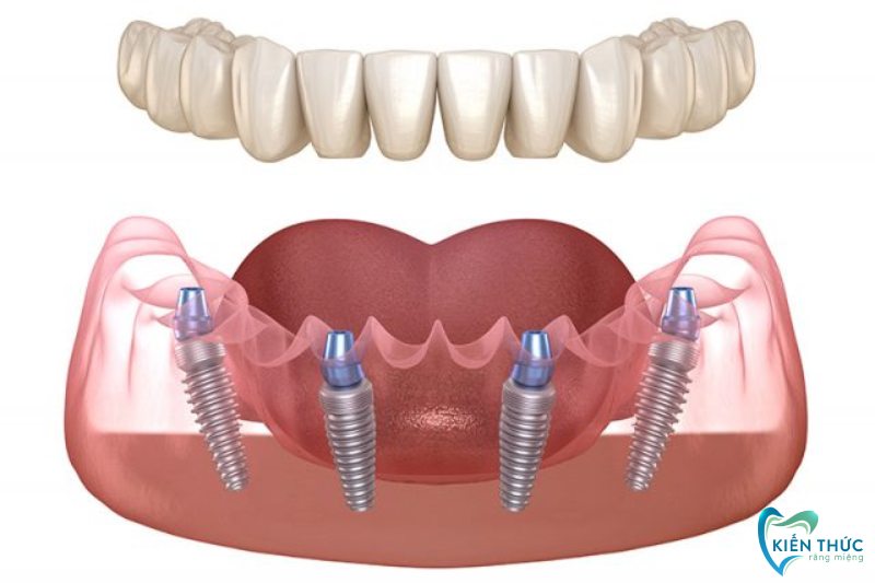 Trồng răng Implant toàn hàm vừa tiết kiệm chi phí vừa mang lại tuổi thọ cao