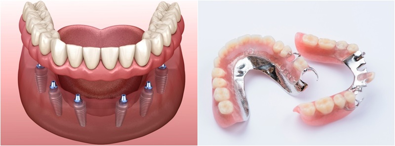 Ưu điểm của trồng răng Implant toàn hàm