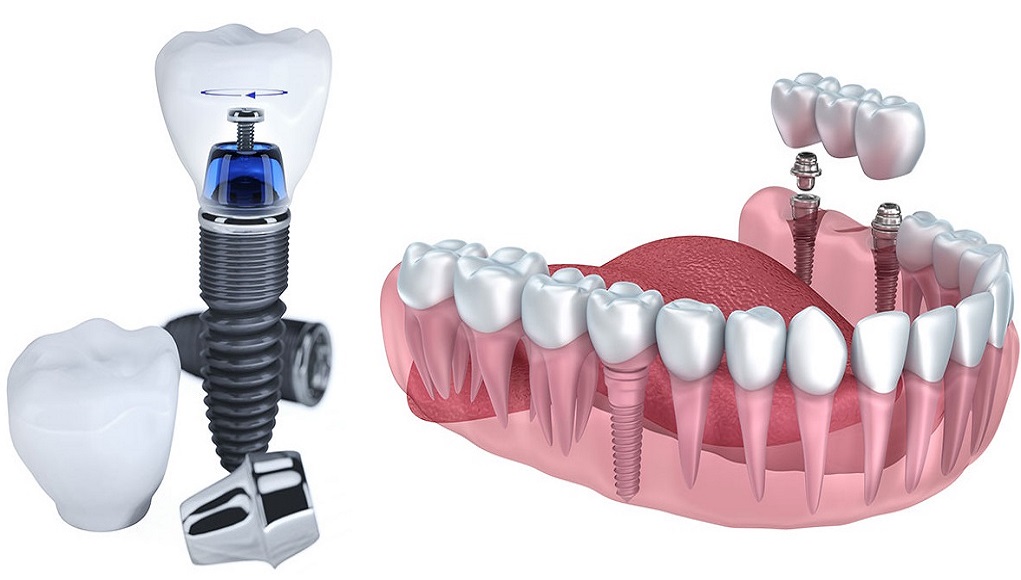 Ưu điểm và nhược điểm của trồng răng Implant