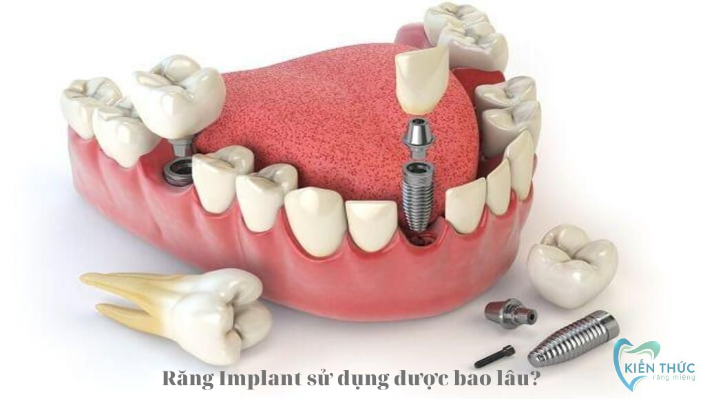 Răng Implant sử dụng được bao lâu? Cách tăng tuổi thọ răng Implant