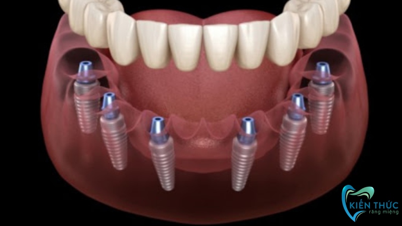 Trồng răng Implant All On 6 là gì?