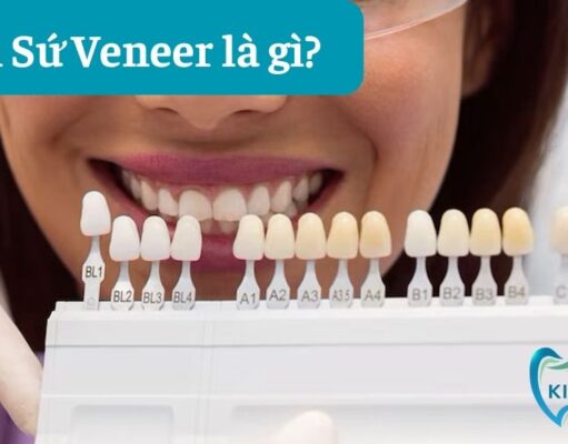 Dán sứ Veneer là gì? 3 điều cần lưu ý khi dán răng sứ Veneer