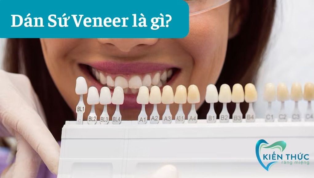 Dán sứ Veneer là gì? 3 điều cần lưu ý khi dán răng sứ Veneer