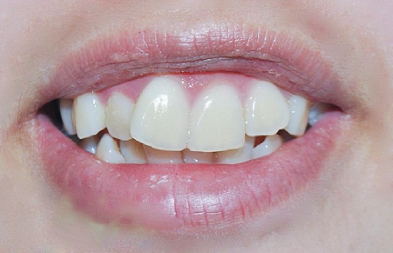 Nhược điểm của dán răng sứ Veneer