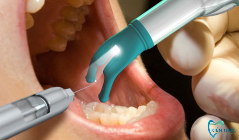 Tiến hành gây tê trước khi mài răng
