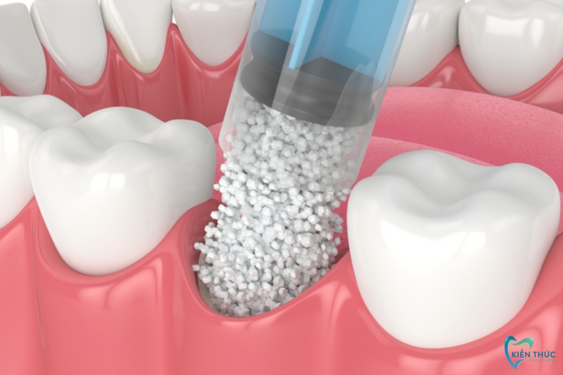 Những lưu ý sau khi ghép xương hàm trong quá trình trồng răng Implant
