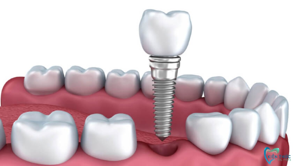 Những lưu ý sau khi trồng răng Implant để mau lành thương
