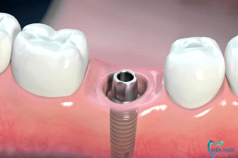 Quy trình chụp mão răng sứ trên trụ Implant