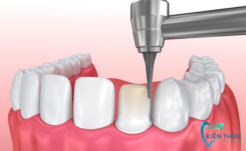 Quy trình chụp mão sứ răng hàm chuẩn Y khoa