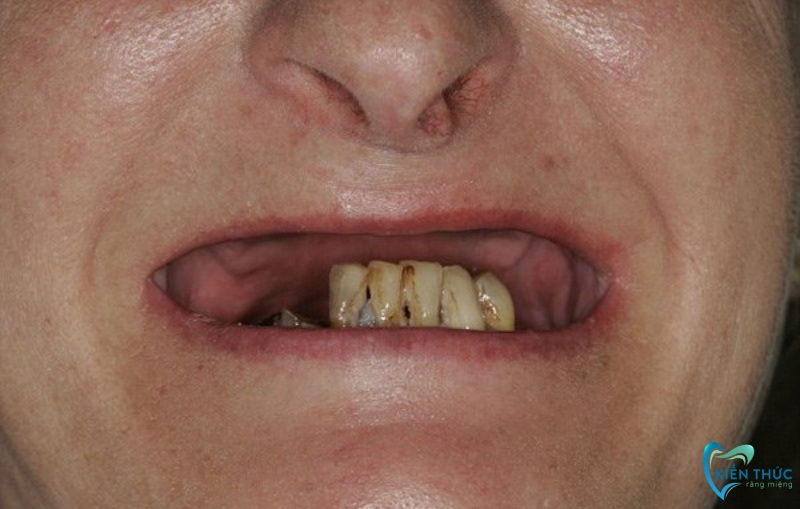 Nguyên nhân gây ra tình trạng mất răng