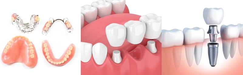 Mất răng lâu năm có thể áp dụng hàm tháo lắp, cầu răng sứ và trồng răng Implant để khắc phục