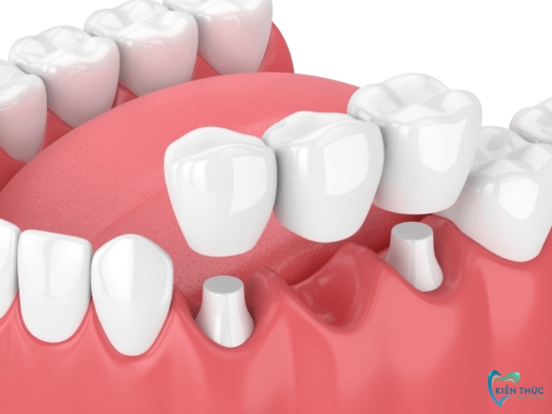 Cầu răng sứ sẽ giúp khắc phục vấn đề mất răng lâu năm có trồng được không