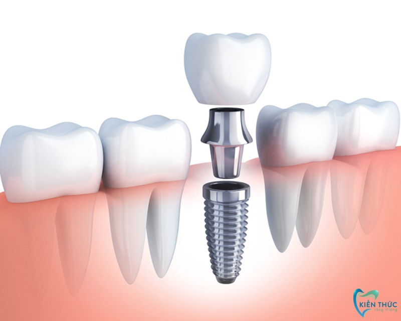 Trồng răng Implant phương pháp khắc phục mất răng hiệu quả và an toàn nhất