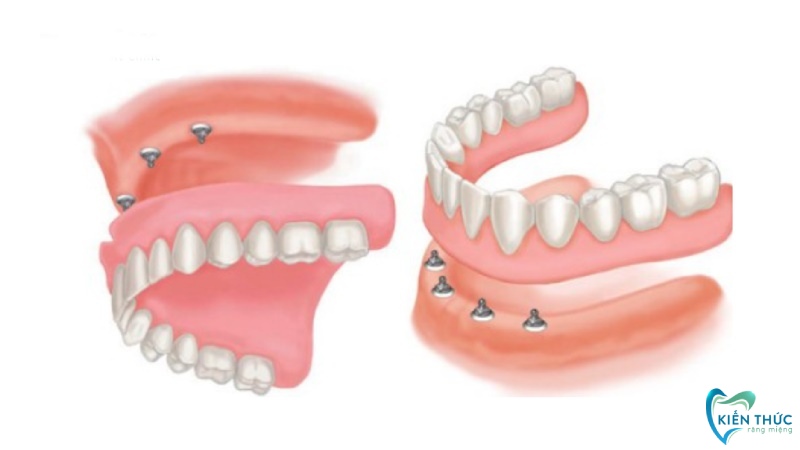 Răng giả tháo lắp trên trụ Implant mang lại cảm giác ăn nhai như răng thật.