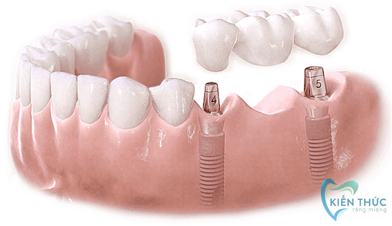Tiêu chí lựa chọn trụ răng Implant chất lượng và phù hợp với xương hàm