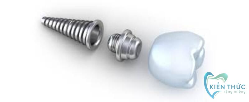 Răng Implant được cấu tạo từ 3 phần
