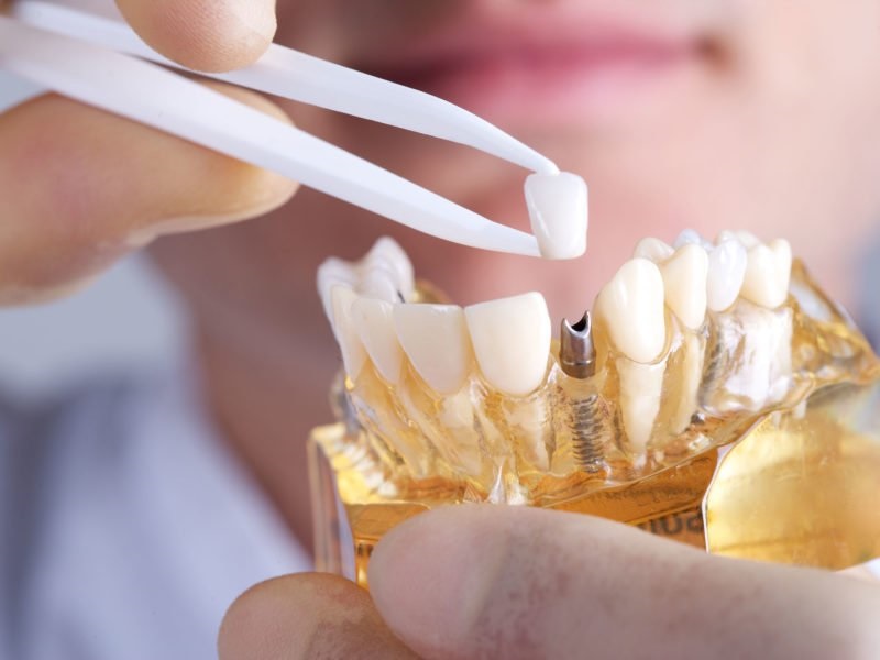 Mão răng sứ được gắn vào Implant Abutment