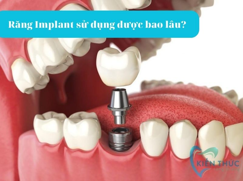 Răng Implant sử dụng được bao lâu?