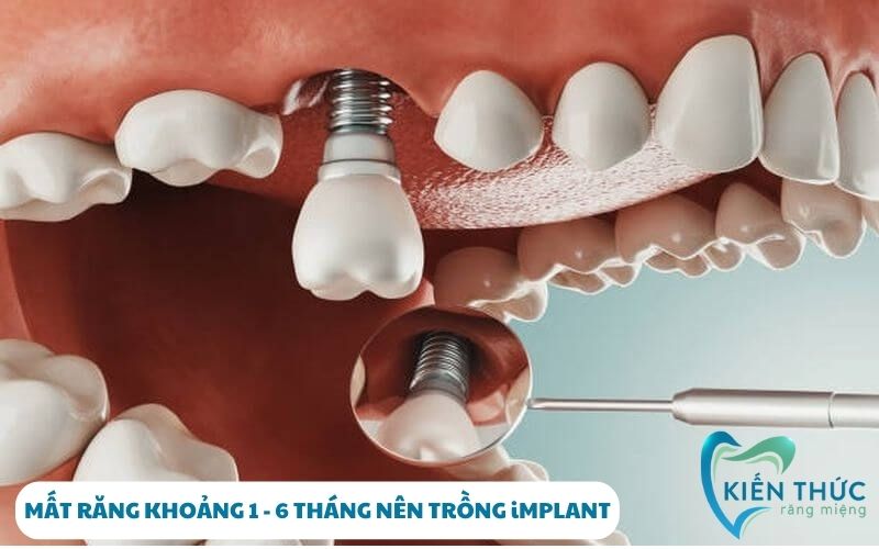 Sau khi nhổ răng bao lâu thì trồng Implant là tốt nhất