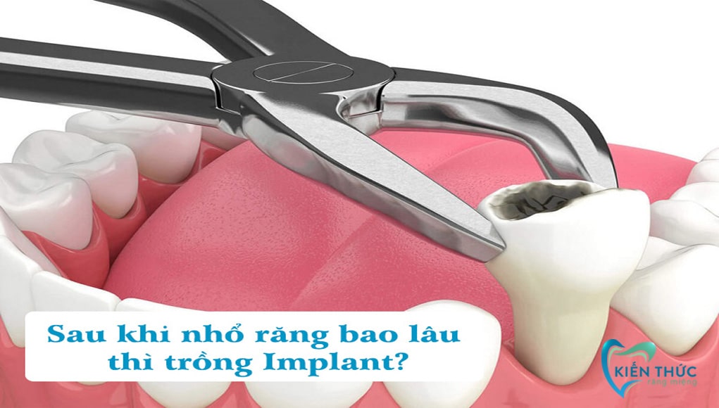 Sau khi nhổ răng bao lâu thì trồng implant là tốt nhất