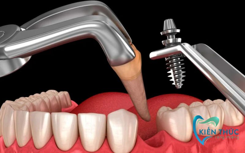 Trồng răng Implant tức thì rút ngắn thời gian điều trị