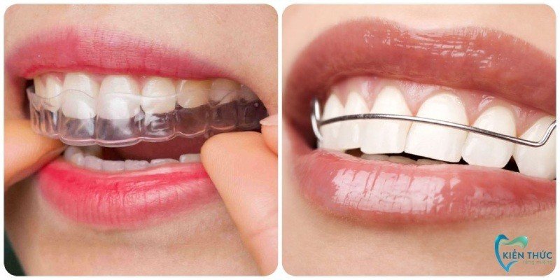 Quy trình niềng răng sau khi cấy ghép Implant