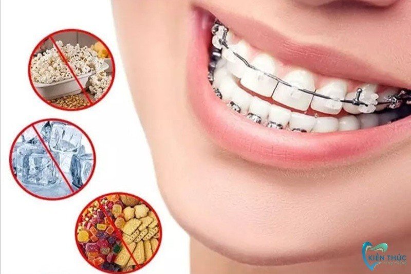Những lưu ý khi niềng răng sau quá trình trồng răng Implant