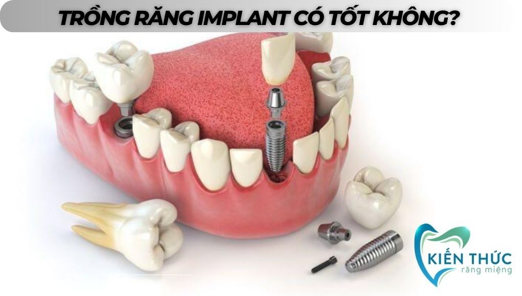 Trồng răng implant có tốt không? Lợi ích của cấy ghép Implant