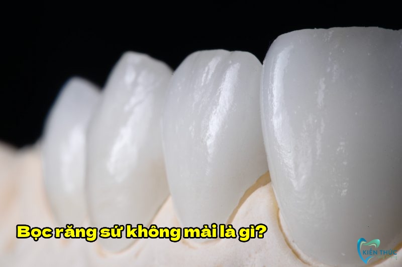 Bọc răng sứ không mài là kỹ thuật dán sứ Veneer