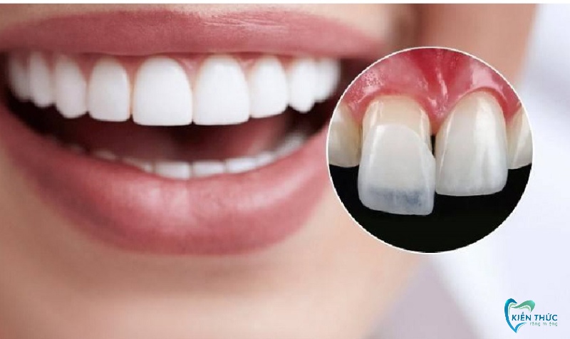 Răng có vẻ tròn, dày hơn bình thường khi dán sứ.
